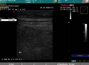 lateraal acuut patellaband letsel.0001