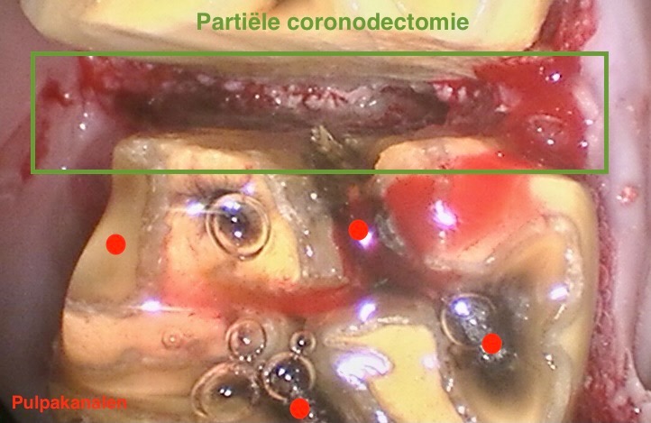 Partiele coronectomie-Moeilijke tandextractie